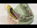 Boxing an altered cast impression for a removable partial denture