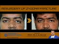 Resurgery of Zygoma Fracture - Dr. SM Balaji, Maxillofacial Surgeon