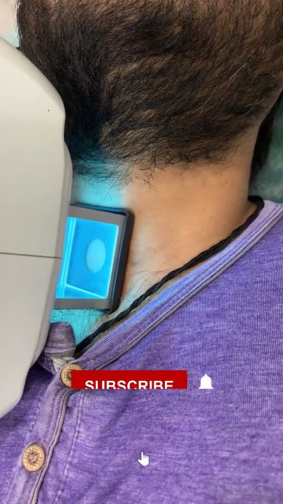 Revive Your Skin! 😍 Excimer Laser for Vitiligo 🎯 | Treat White Patches | Skinaa Clinic #shorts