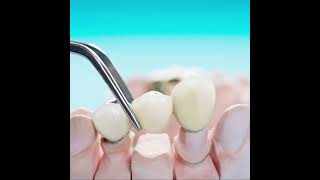 حماية أسنانك مبتقفش عند علاج التسوس أو الحشو 