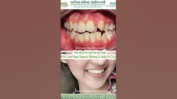 Niềng răng chen chúc trước và sau tại Nha khoa AVA  #niengrang #niềngrăngtrongsuốt #niengrangmom