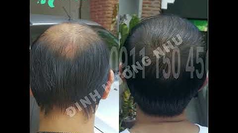 Thuốc chống hói đầu - rụng tóc, giúp tóc mọc nhanh chắc khỏe