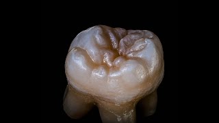 Why I don't like immediate dentures and implant placement at the same time.