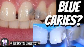 AMAZING Tooth Restoration w/ Gap Closure #C36 #4k