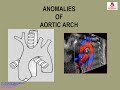 Fetal Echocardiography – Anomalies of Aortic Arch