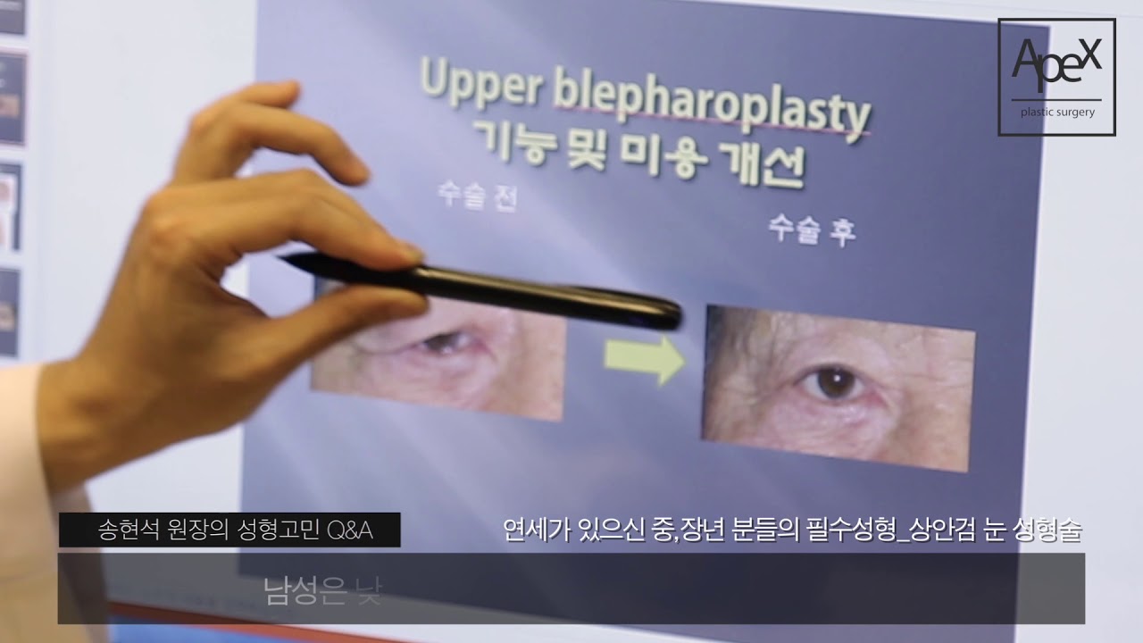 [Apex 성형외과] [Q&A về phẫu thuật thẩm mỹ] Tư vấn trước cùng bác sĩ chuyên khoa phẫu thuật thẩm mỹ Song Hyeon-seok, Trưởng khoa của Apex 성형외과 "Q&A về phẫu thuật thẩm mỹ" phần_Phẫu thuật tạo hình mí mắt trên