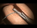 Animation of Urolift® System for BHP - Treatment now available at Genesis Healthcare