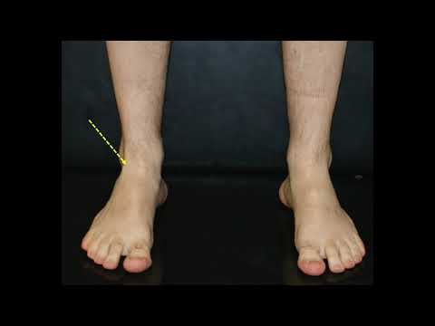 Video: I monitor della caviglia possono rilevare i farmaci?