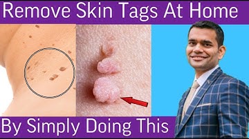 Remove Skin Tags | Home Remedies To Remove Skin Tags | Dr. Vivek Joshi
