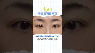 무쌍 절개 눈매교정 후기
