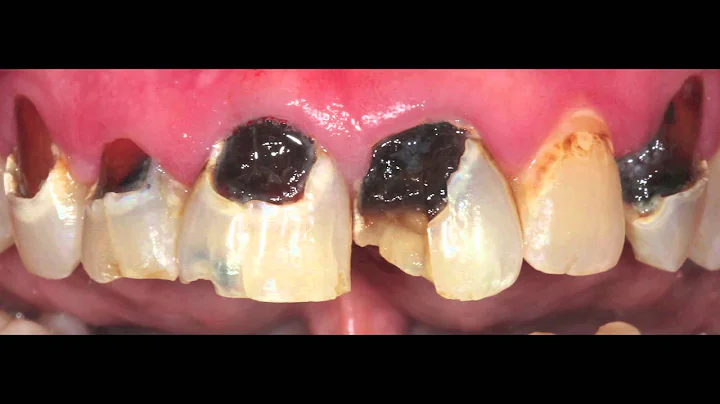 Before & After Smile Makeover Transformations Innovative Dental