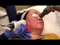 Fraxel Laser Treatment | La Jolla Cosmetic Laser Clinic