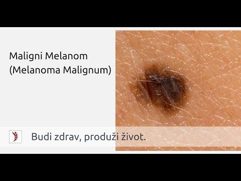 Video: Može li akralni lentiginozni melanom biti benigni?