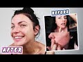 HOW TO CLEAR YOUR ACNE! *Skin Transformation*