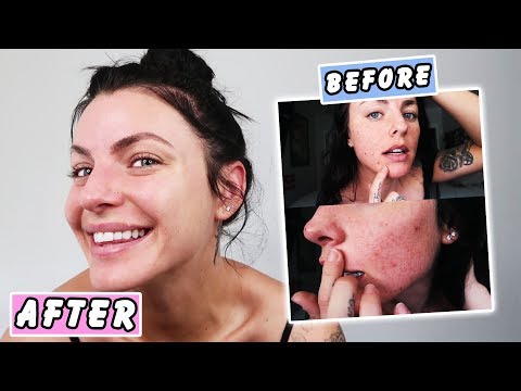 HOW TO CLEAR YOUR ACNE! *Skin Transformation*