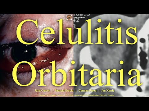 Celulitis Orbitaria.