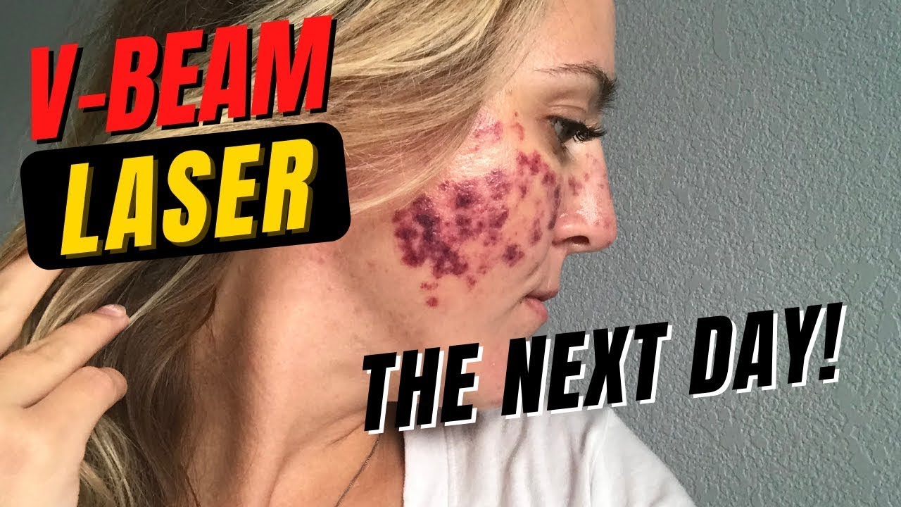 VBEAM LASER did THIS to my face. Before and After! YouTube