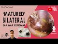 642 - 'Matured' Ear Wax Removal