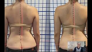 How to Correct Scoliosis, Naturally: St Jude's Clinic Resimi
