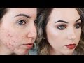 Updated Acne Coverage Foundation Routine DRUGSTORE FULL COVERAGE