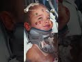 بعد انفصال رأسه عن عموده الفقري معجزة تنقذ طفلا صغيرا