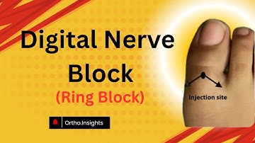 How to perform a Digital Nerve Block or Ring Block? #ortho #insights #digital #nerve #Block #Foot