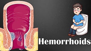 Hemorrhoids :- Types, Causes, Risk Factors, Signs \& Symptoms, Diagnosis, \& Treatment