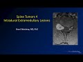 Spine tumors 4 – Intradural Extramedullary Lesions