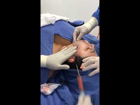 Video: Chees Liposuction: Procedure, Recovery, Cost