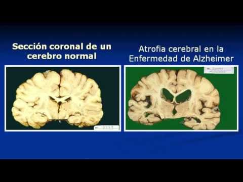 Vídeo: Mediciones Beta De Amiloide En Plasma: Un Biomarcador De La Enfermedad De Alzheimer Deseado Pero Difícil De Alcanzar