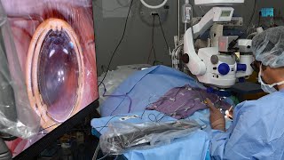 مستشفى الملك خالد التخصصي للعيون يجري العملية الثالثة من نوعها لمعالجة مريضين مصابين