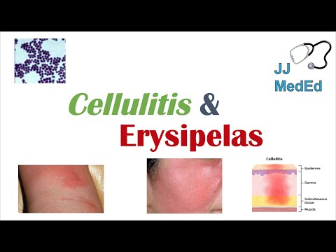 Video: Erysipelas - Symptoms, Causes And Prevention Of Erysipelas