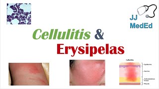 Cellulitis vs Erysipelas | Bacterial Causes, Risk Factors, Signs and Symptoms, Treatment