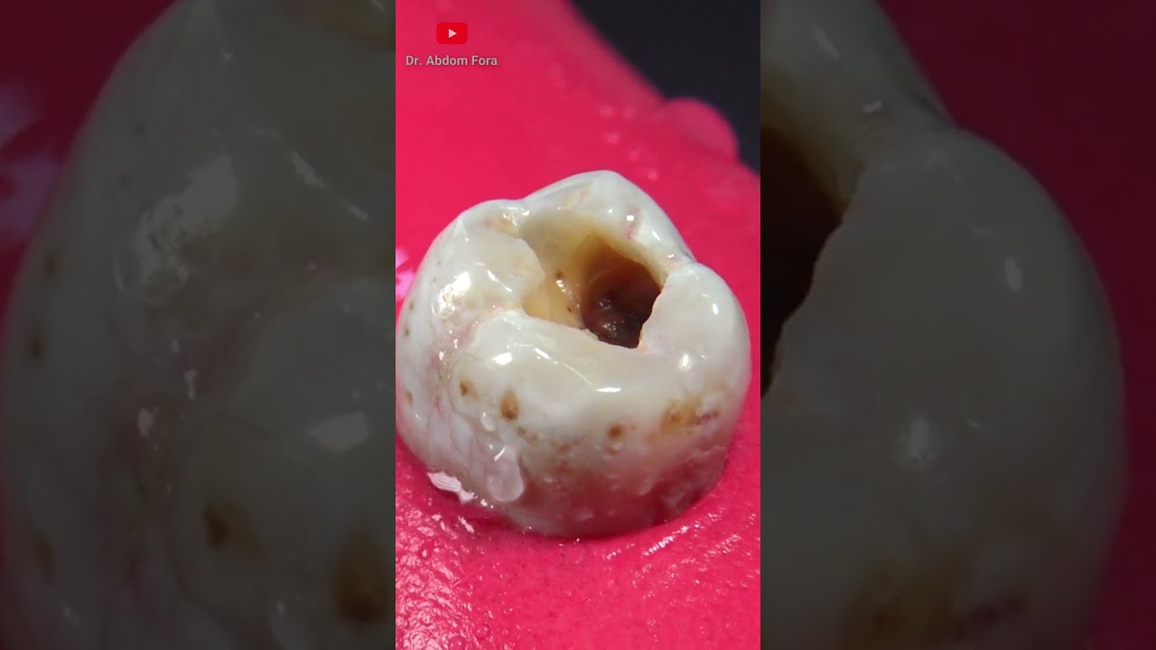 удаление кариеса АСМР