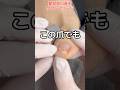この巻き爪でも巻き爪矯正できるかな?