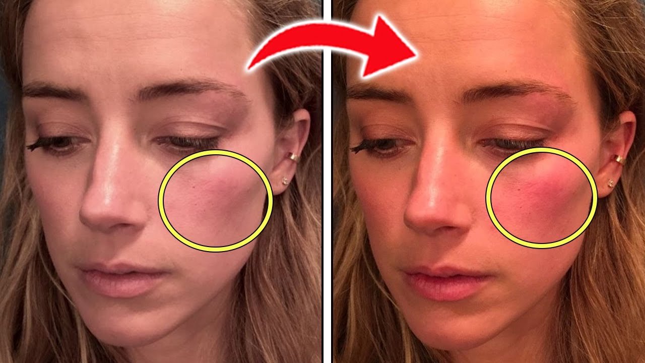 Amber Heard Could Face Jail Time For FAKING Bruise Photos