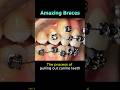 Braces process: Pull out canine teeth, good job dentist #braces #orthodontist #orthodontics #dental
