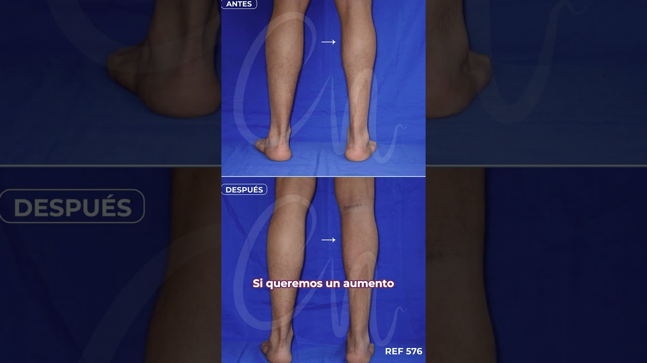 ¿GRASA o IMPLANTES DE PANTORRILLA 🤔🦵🏼? #fyp #parati #draclaudianieto #cirugíaplástica #viralshort