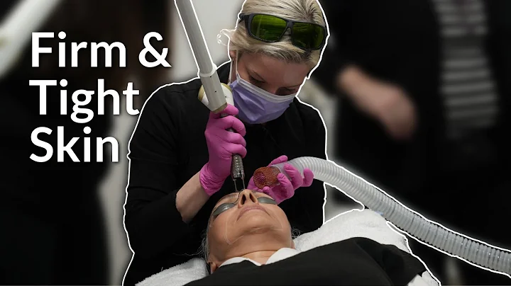 Progress Diaries for Fotona Skin Tightening | Lucere Skin