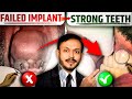 Conventional implant fail          immidiate implant place   fix dant hua