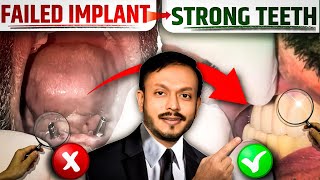 Conventional Implant fail हो चुका था 😕 ! बची हुई जगह में immidiate implant place कर के fix dant hua