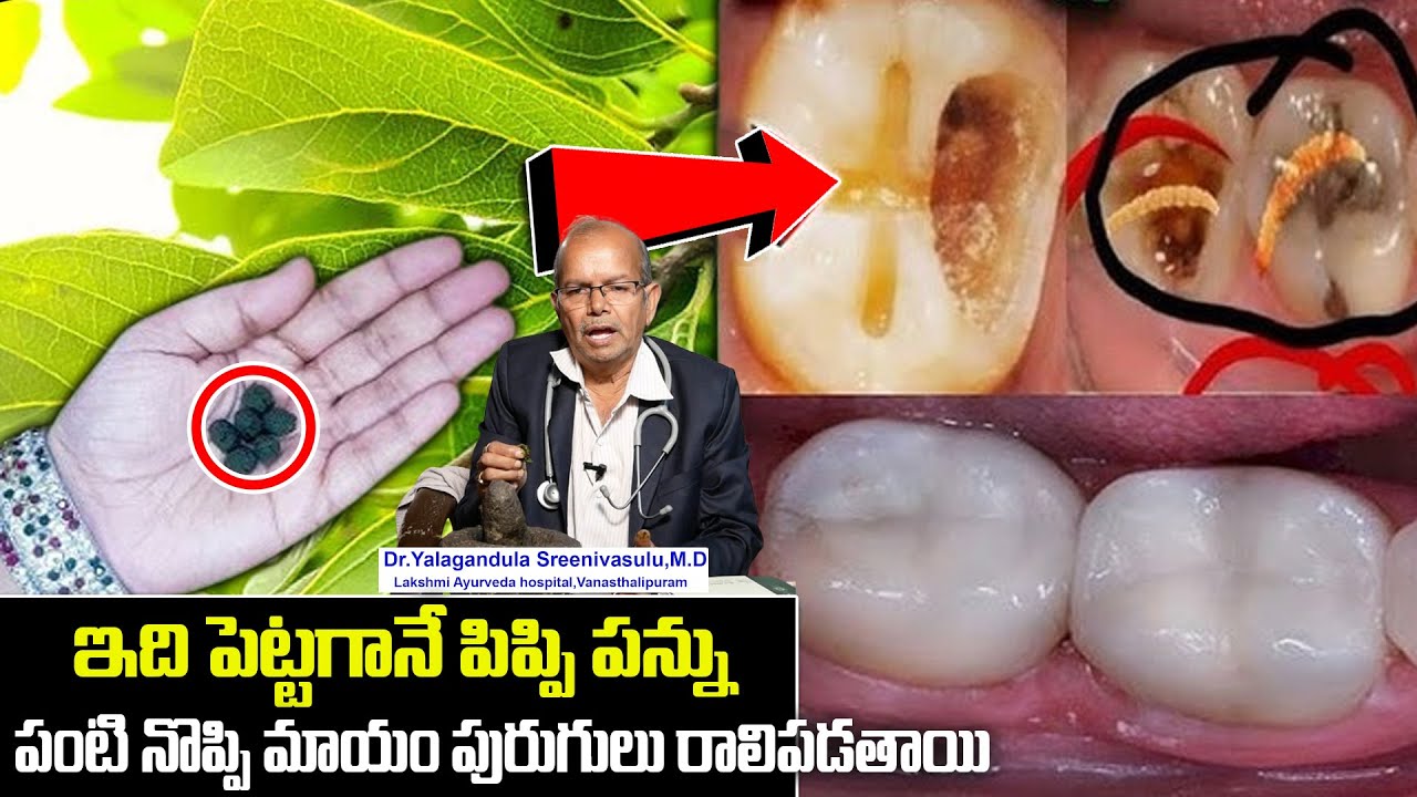 Y.Srinivasulu - పిప్పి పన్ను పంటి నొప్పి మాయం | Pippi Pannu Remedy || Dental Cavities | Sumantv
