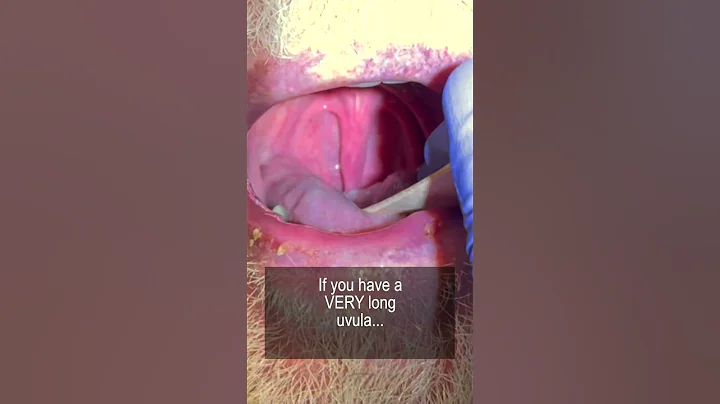 Long Uvula and Snoring #shorts @fauquierent
