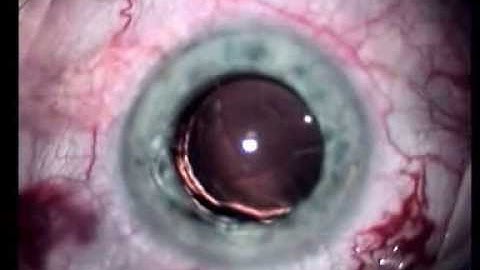 Safe Insertion of a Rayner IOL, Cataract Surgery
