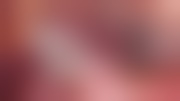 Laparoscopic Extended Right Hepatectomy