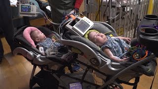 Conjoined twins connected at the heart and liver successfully separated at UF Health