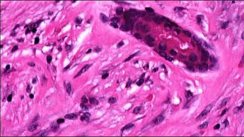 Pathology of Inclusion Body Fibromatosis (Infantile Digital Fibromatosis) by Dr Sampurna Roy MD