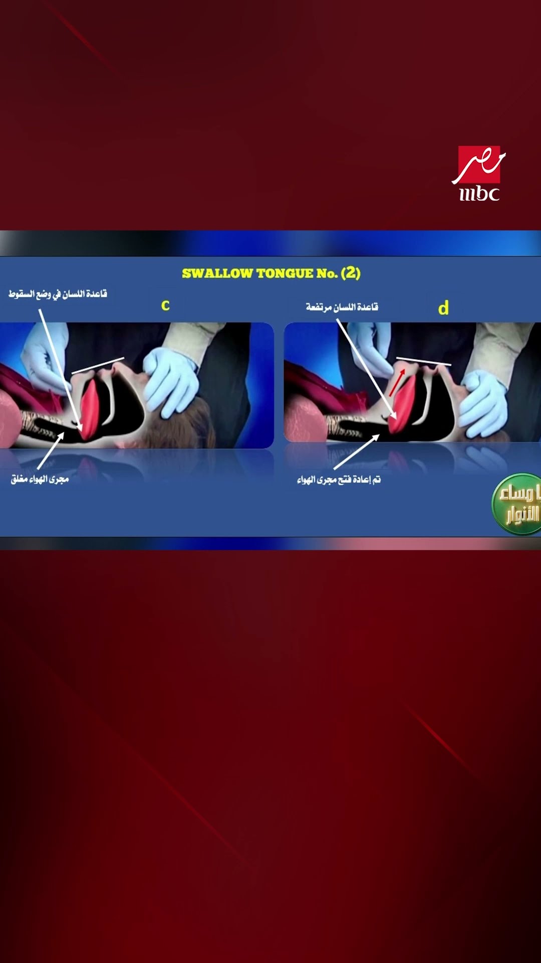 يا مساء الأنوار | إزاي تنقذ حالة «بلع اللسان» بحركة واحدة