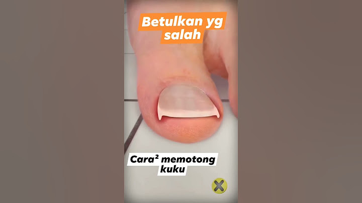 Cara potong kuku kaki yang benar