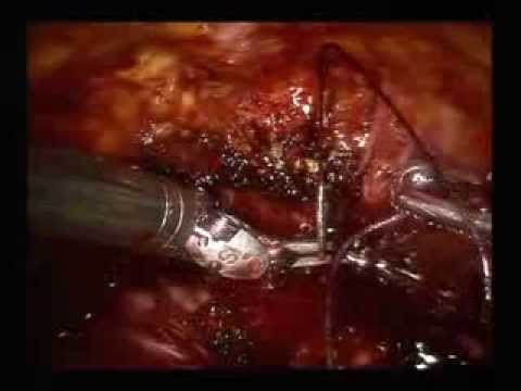 surgeon D: dissection of the apex and section of the urethra1]